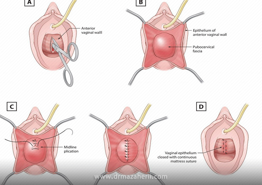 ترمیم واژن بعد از زایمان و برخی از مشکلات واژن