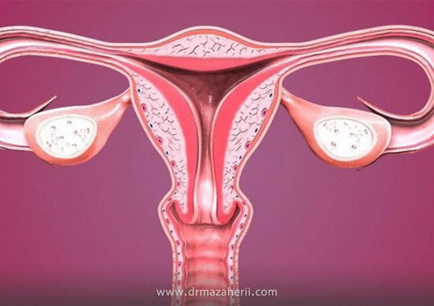 تنبلی تخمدان چیست و چگونه درمان می‌شود؟